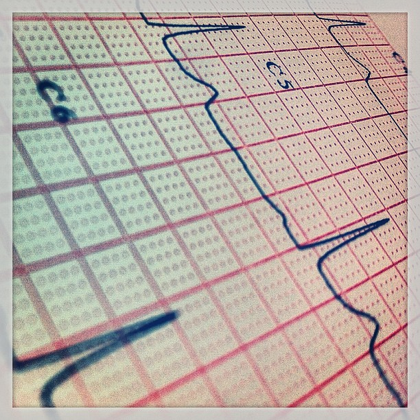 Photo of part of an EKG